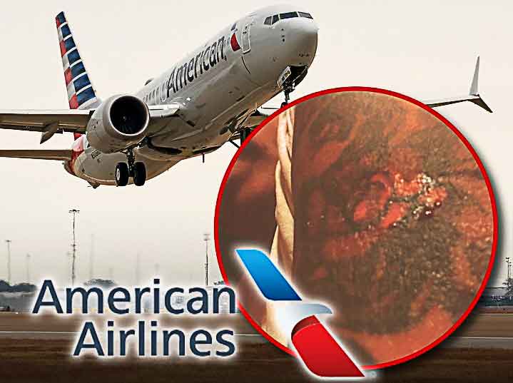 American Airlines Passenger Burnt By Coffee Spill